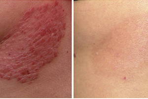 dermaseptic cream избавляет от псориатических бляшек