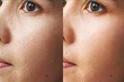 Капсулы Perfectskin очищают кожу от отмерших частичек.