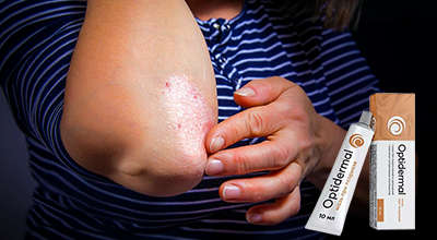 optidermal-ot-psoriaza